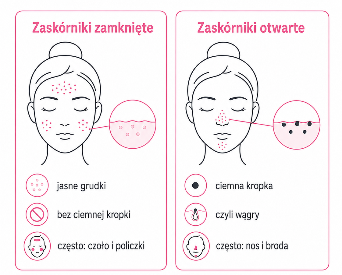 jak odroznic zaskorniki